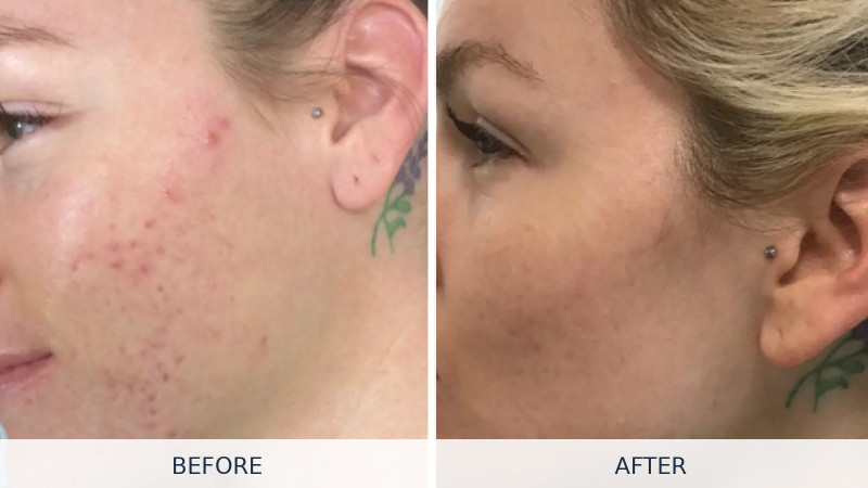 SKINPEN® PRECISION ELITE