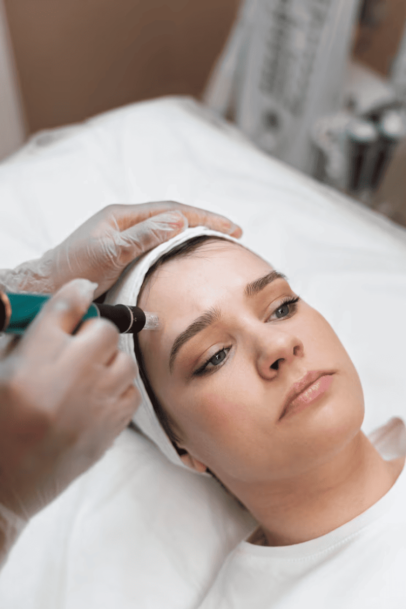 Microneedling